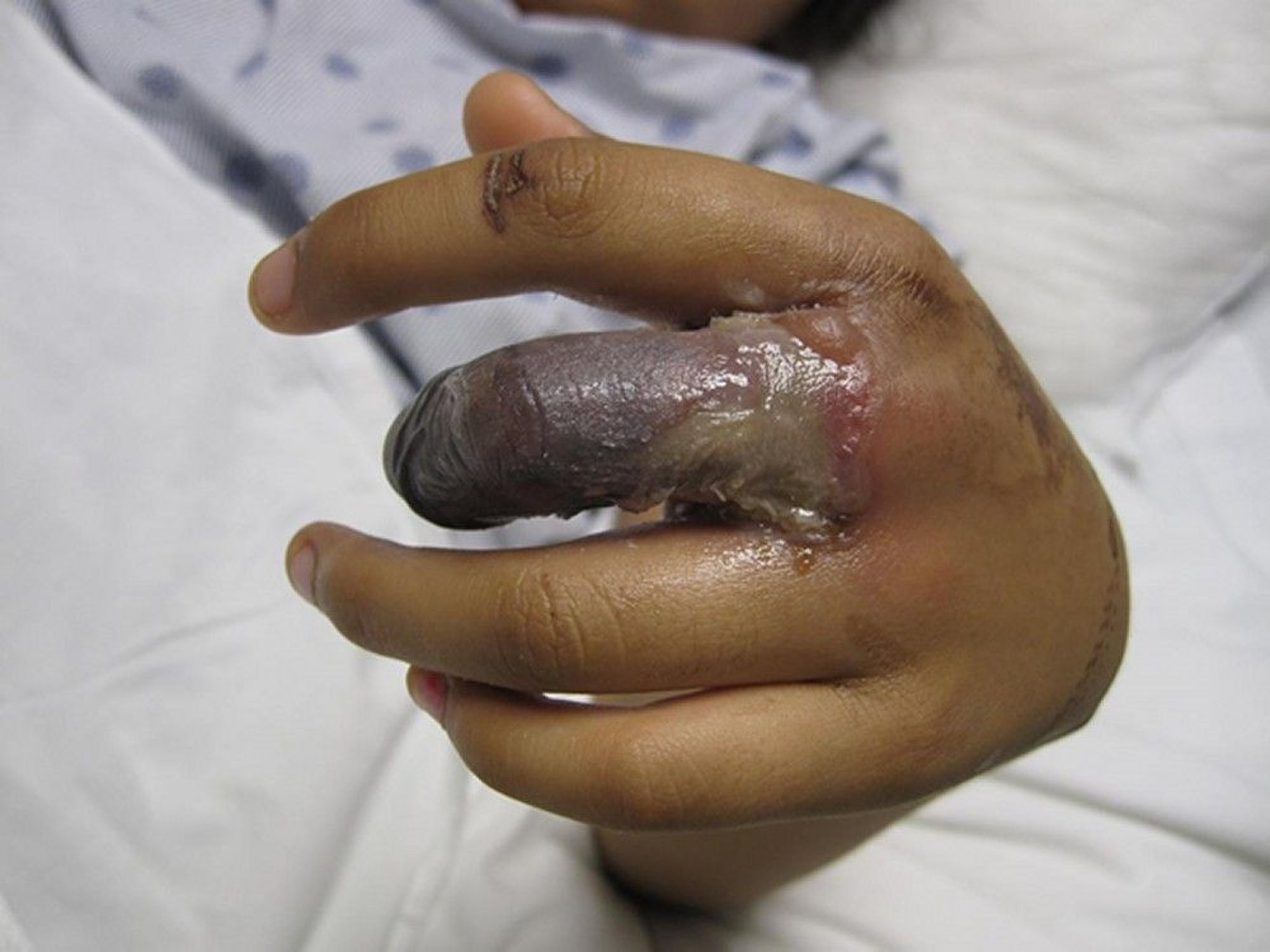 Full-Thickness (Third-Degree) Burn