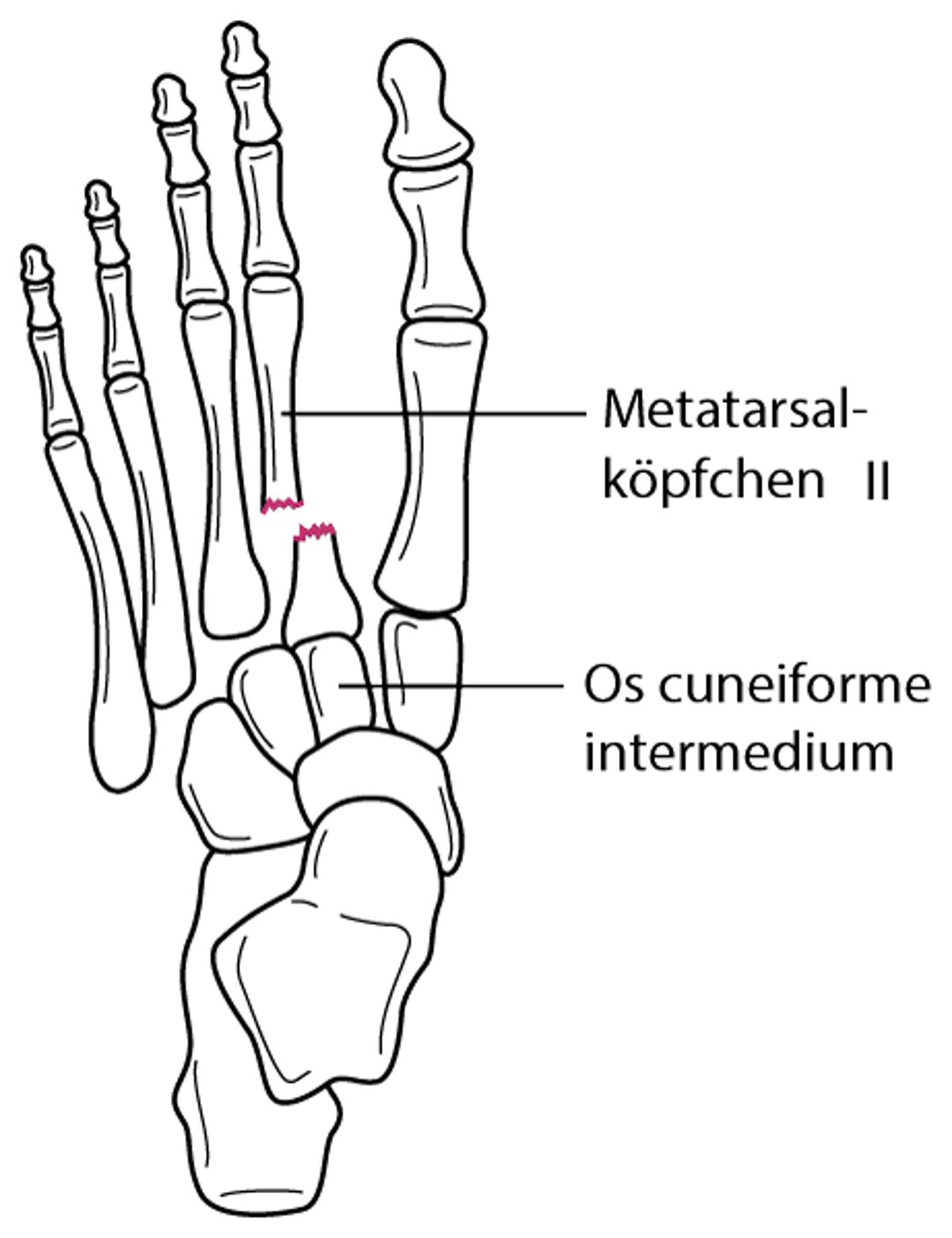 Fraktur an der Basis des II. Metatarsale mit tarsometatarsaler Gelenkluxation