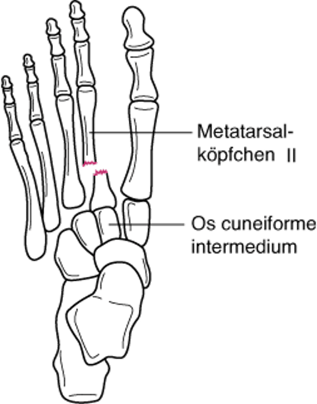 Fraktur an der Basis des II. Metatarsales mit tarsometastarsaler Gelenkislokation