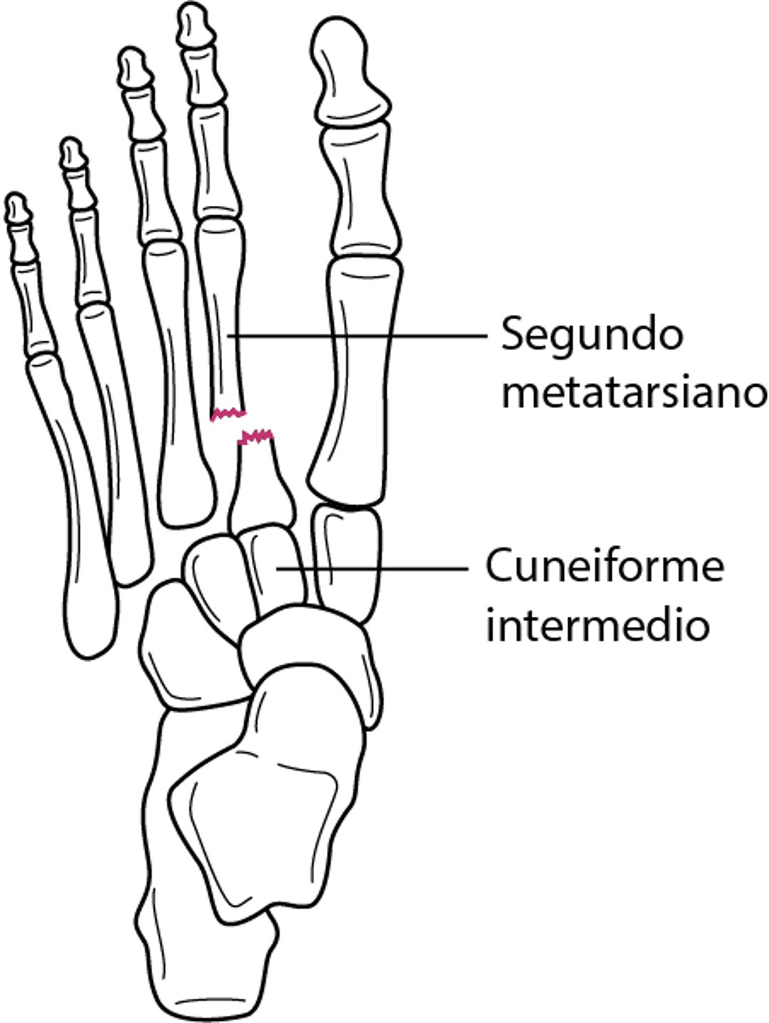 Fracturas de la base del segundo metatarsiano con luxación de la articulación tarsometatarsiana