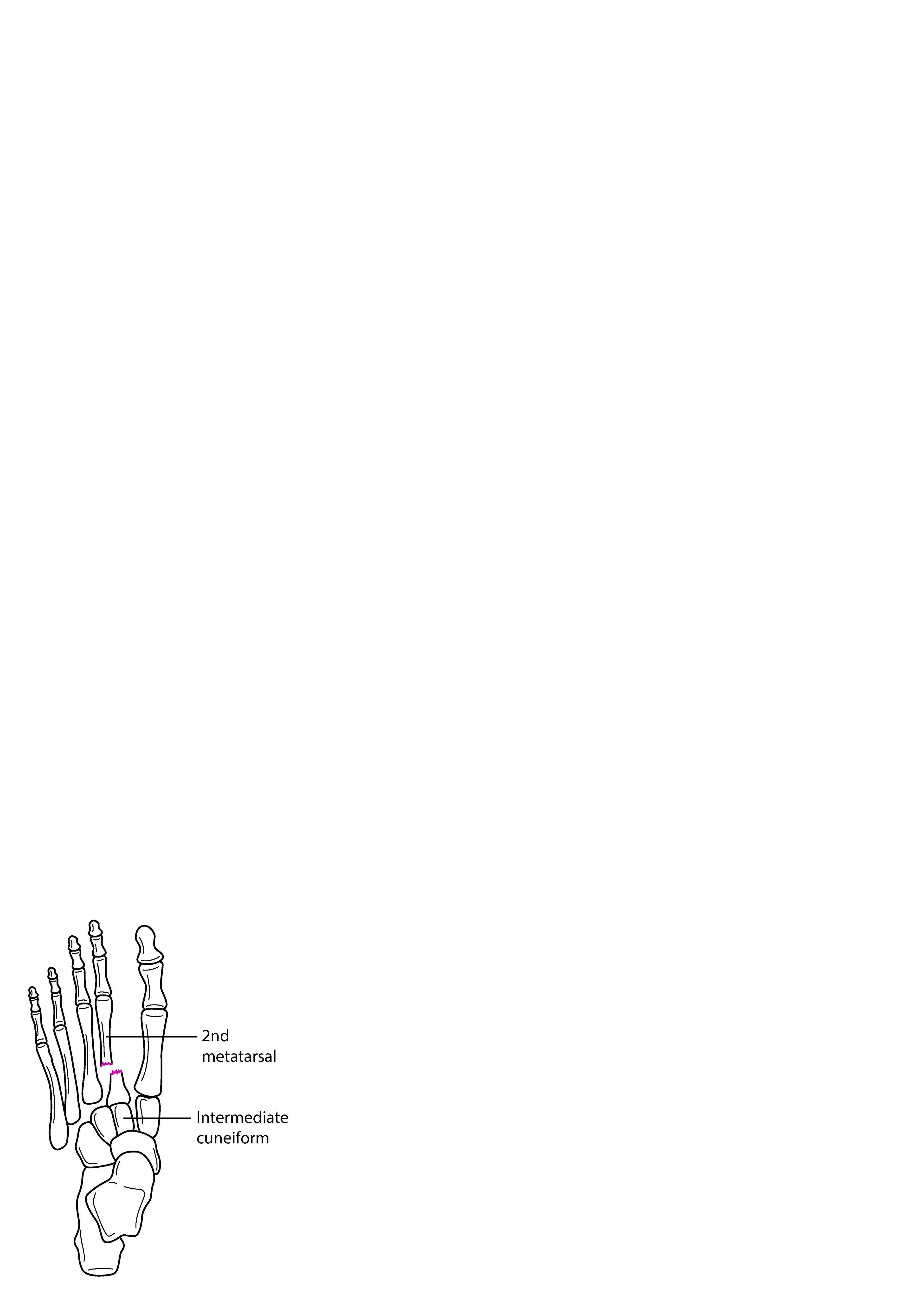 Fracture de la base du 2e métatarsien avec luxation de l'articulation tarsométatarsienne