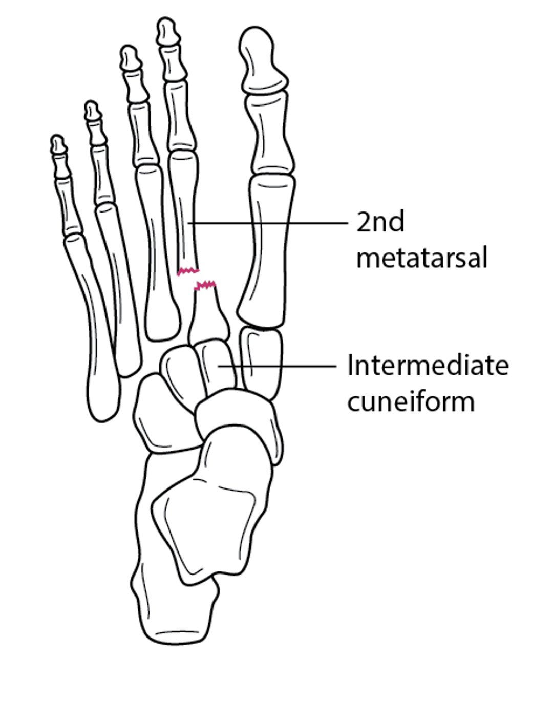 Fracture de la base du 2e métatarsien avec luxation de l'articulation tarsométatarsienne
