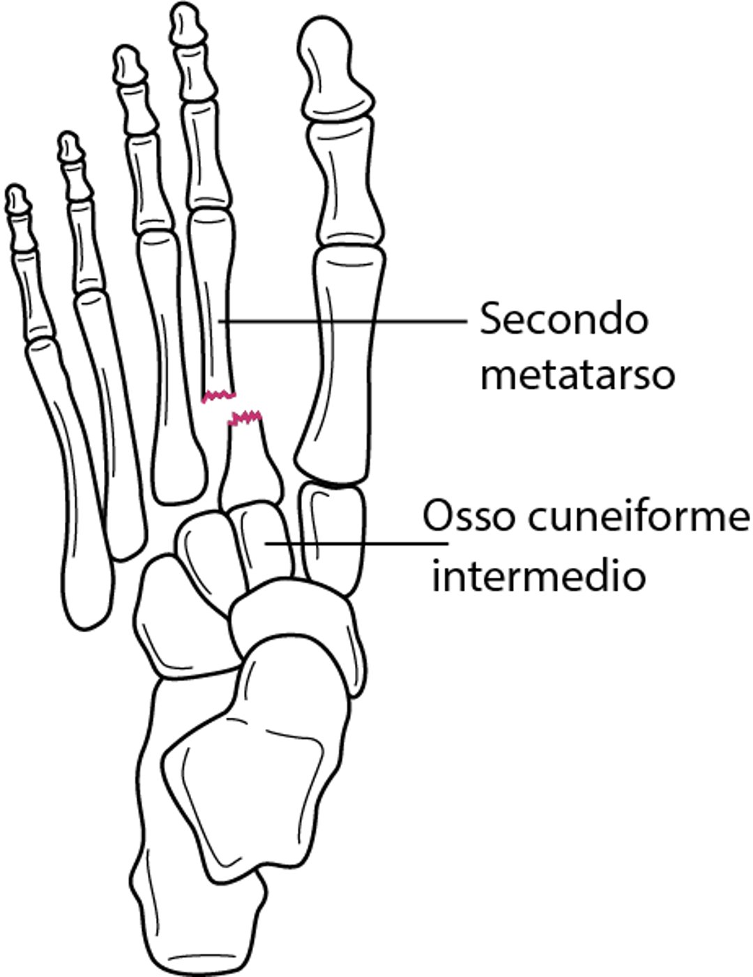 Frattura della base del 2o osso metatarsale con lussazione tarsometatarsale