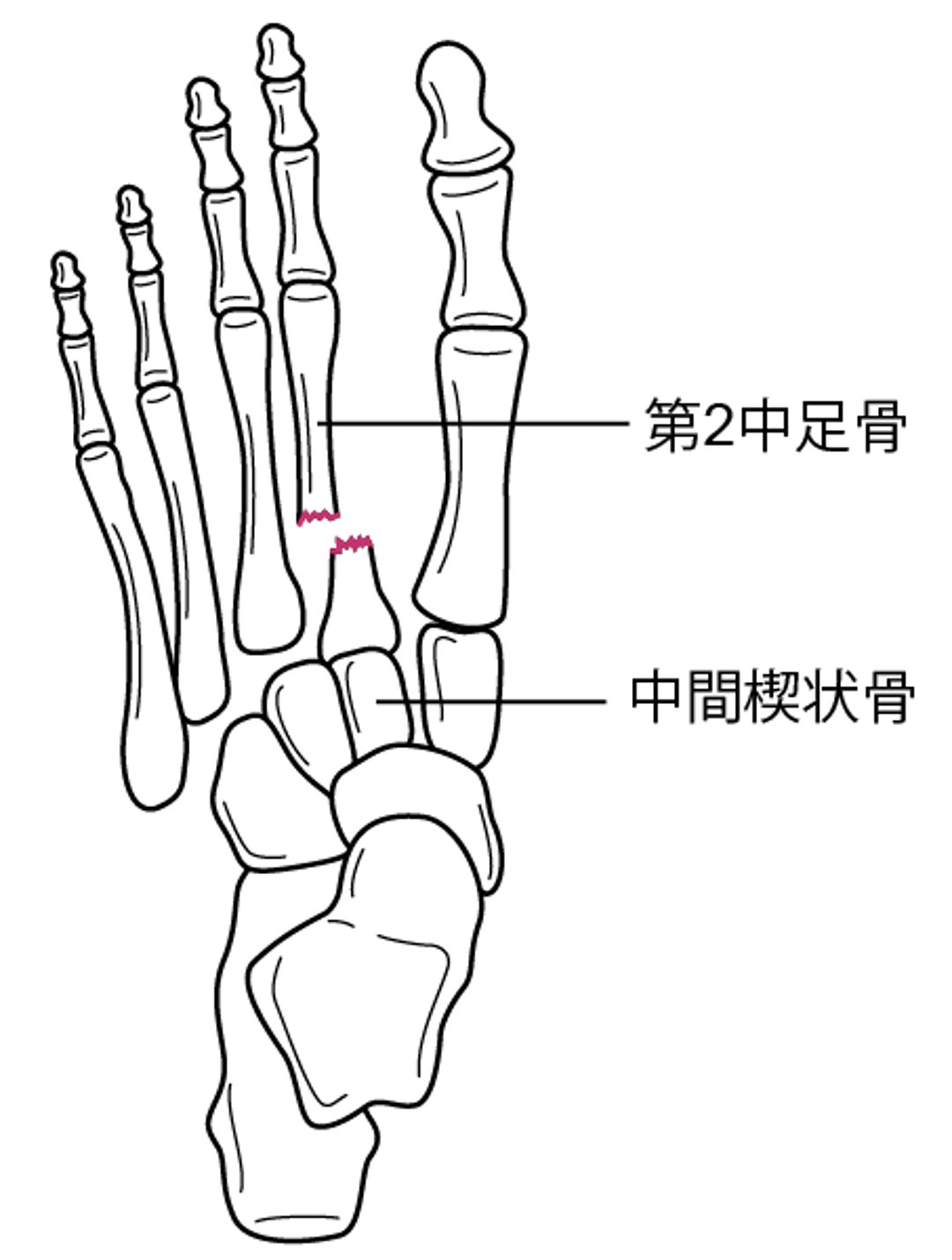 足根中足骨関節脱臼を伴う第2中足骨基部骨折