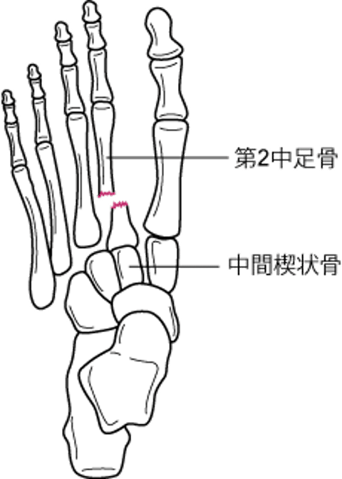 足根中足骨関節脱臼を伴う第2中足骨基部骨折