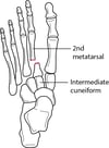 Fratura na base do 2º metatarsal com deslocamento da articulação tarsometatarsal