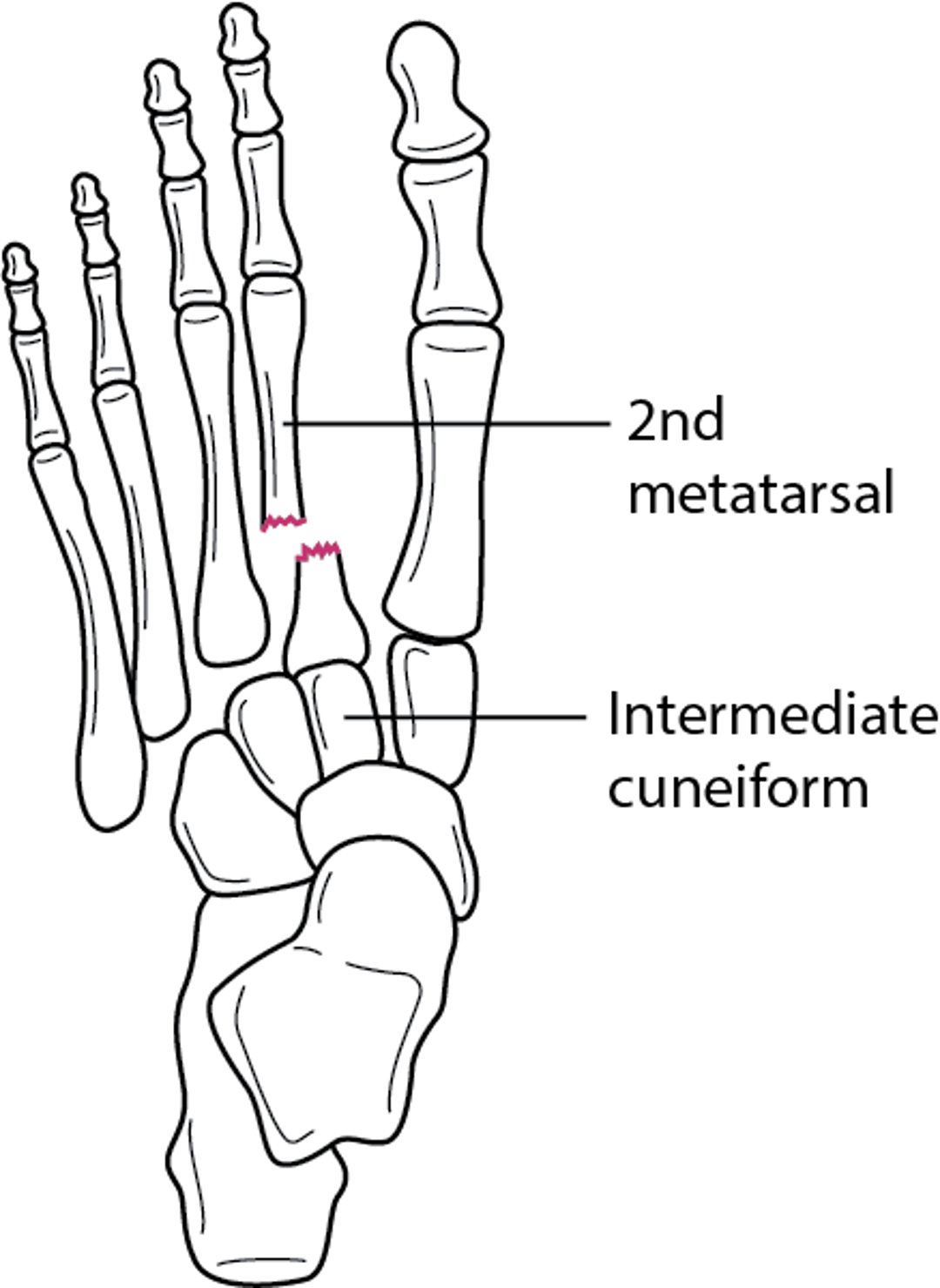 Fratura na base do 2º metatarsal com deslocamento da articulação tarsometatarsal