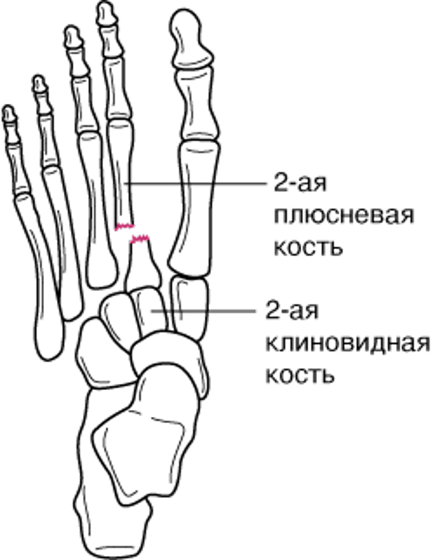 Переломы основания II плюсневой кости (вывих предплюсне-плюсневого сустава)