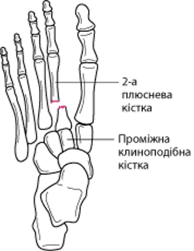 Перелом основи 2-ої плеснової кістки з вивихом заплесно-плеснового суглобу
