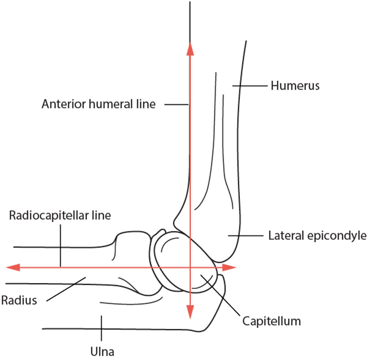 Linha umeral anterior e linha radiocapitelar