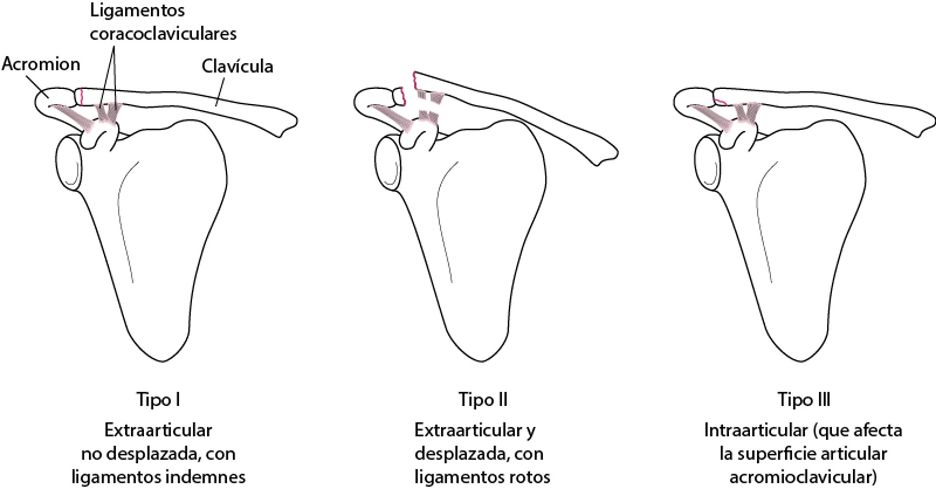 Fracturas claviculares clase B