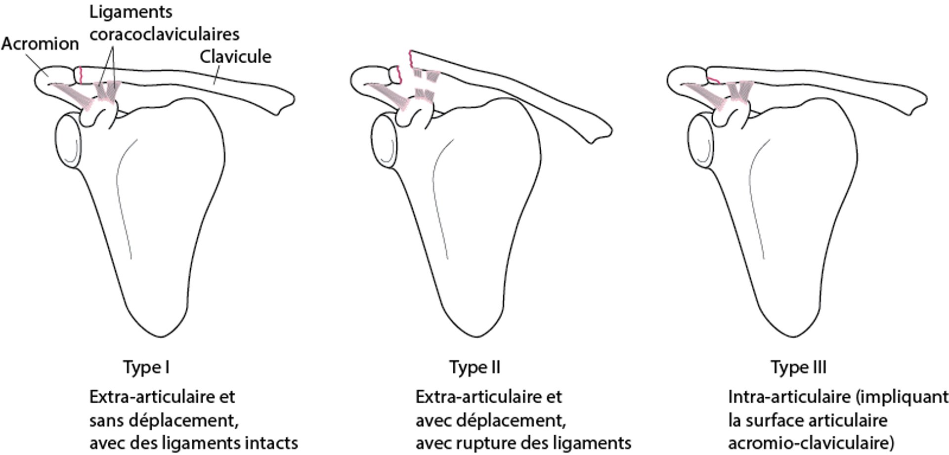 Fractures de la clavicule de classe B