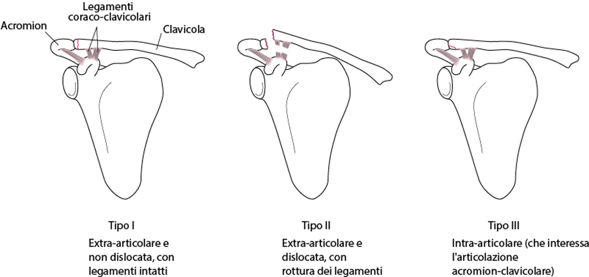 Classe B delle fratture della clavicola