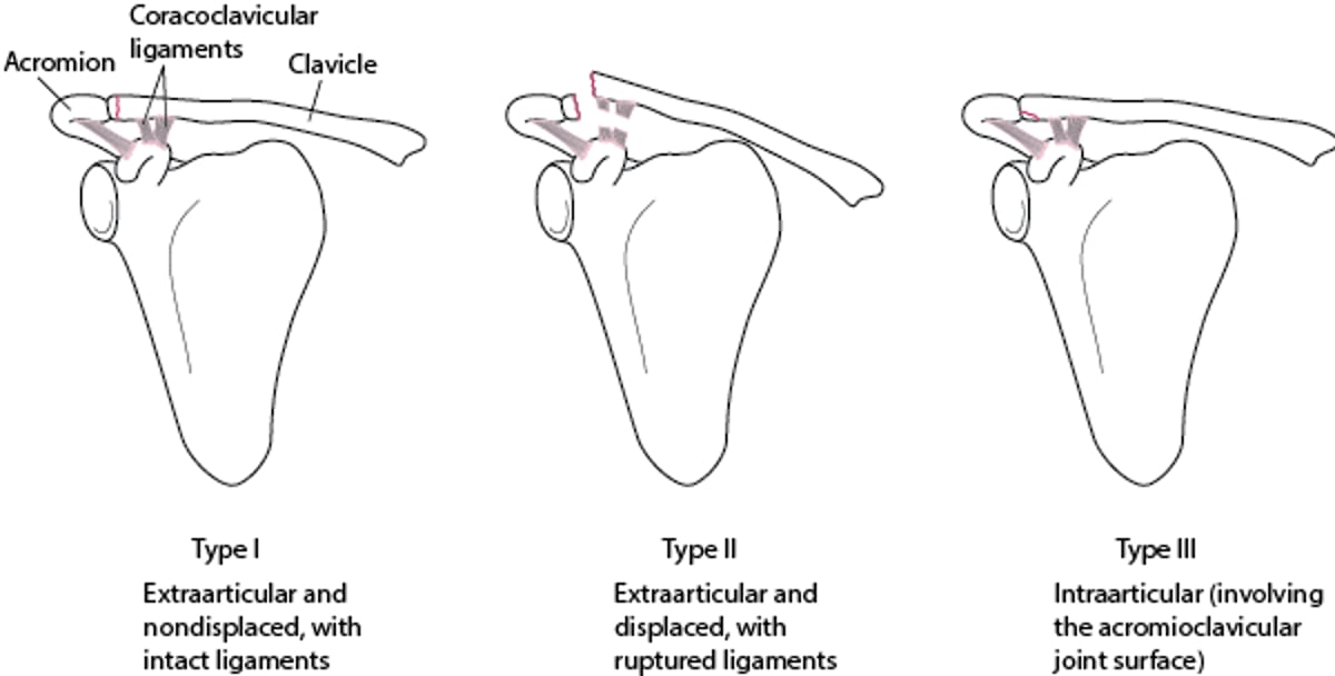 Fraturas de clavícula de classe B
