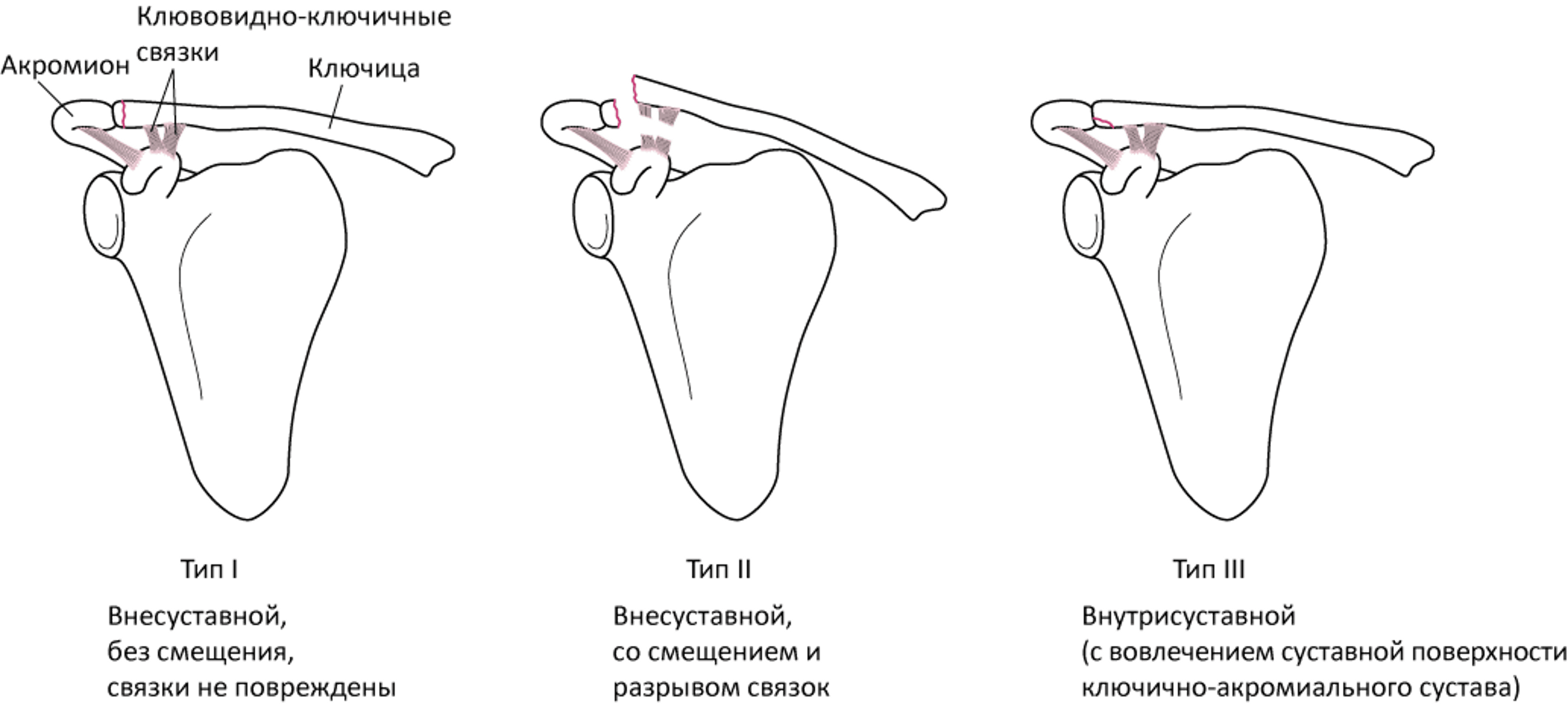 Переломы ключицы класса B