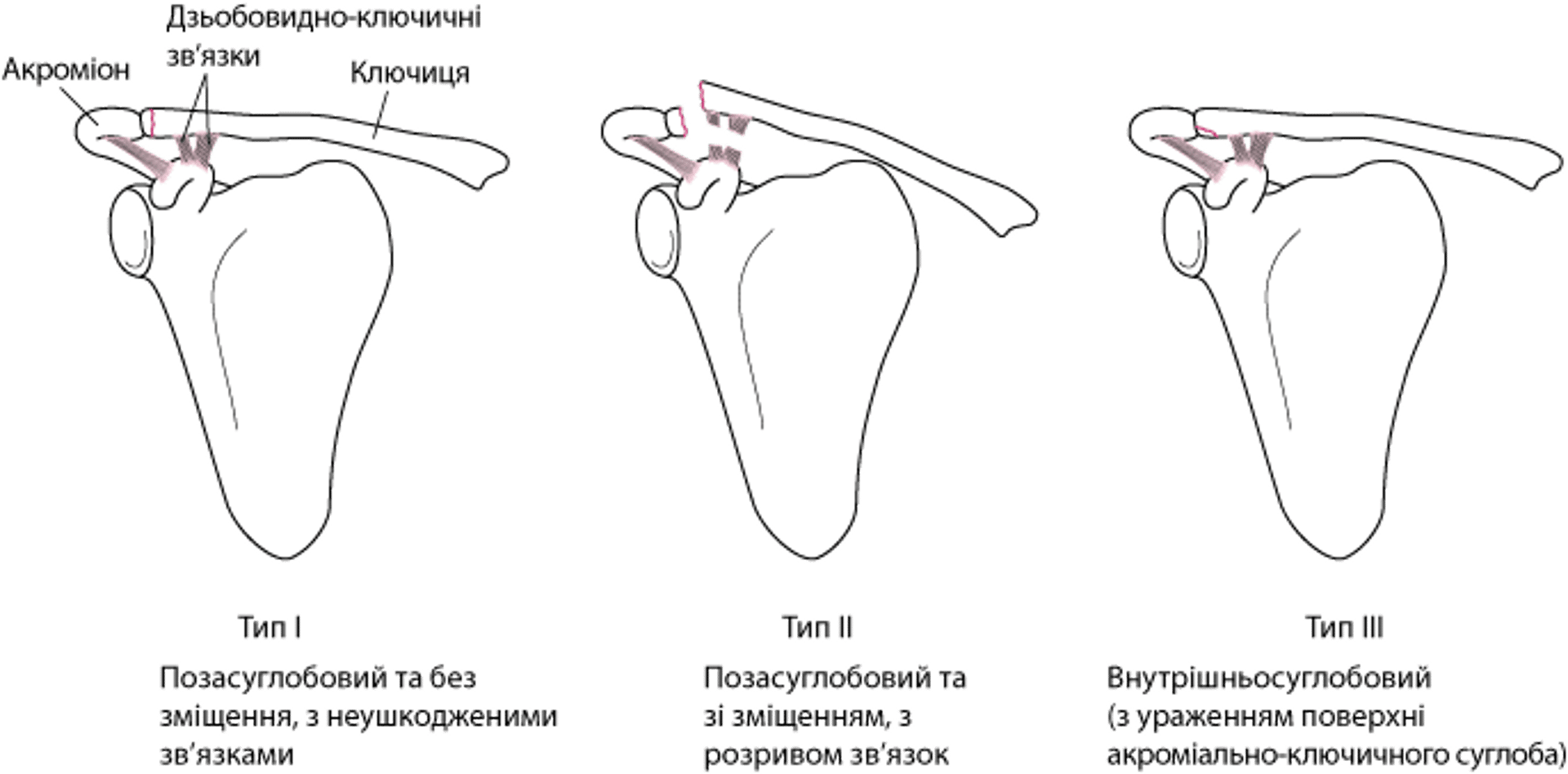 Переломи ключиці класу B