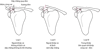 Gãy xương đòn loại B