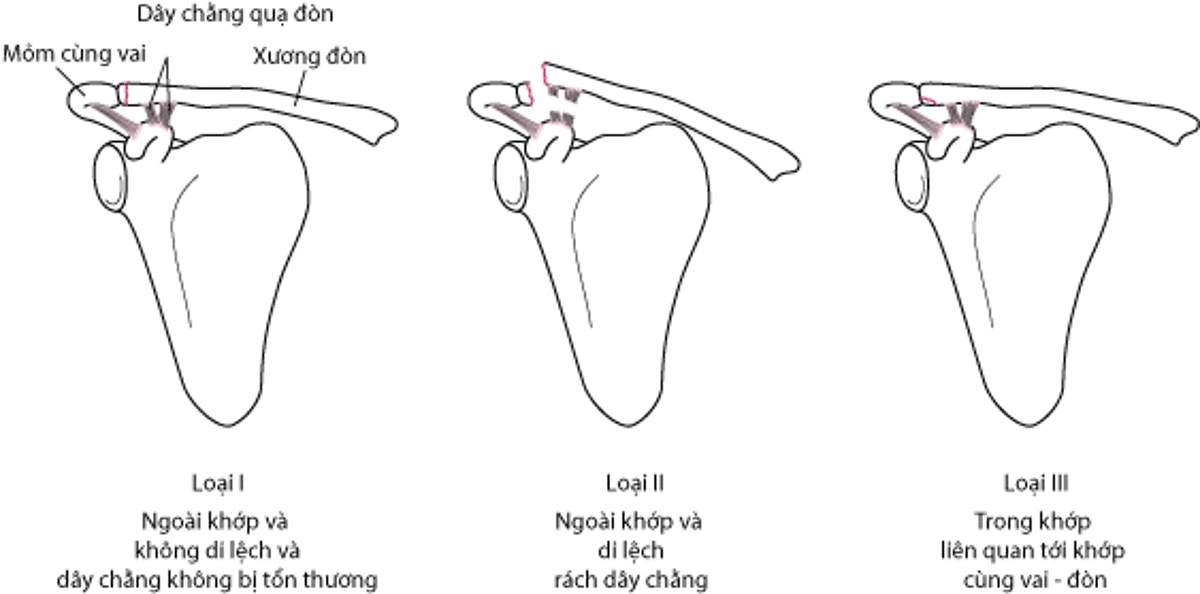 Gãy xương đòn loại B