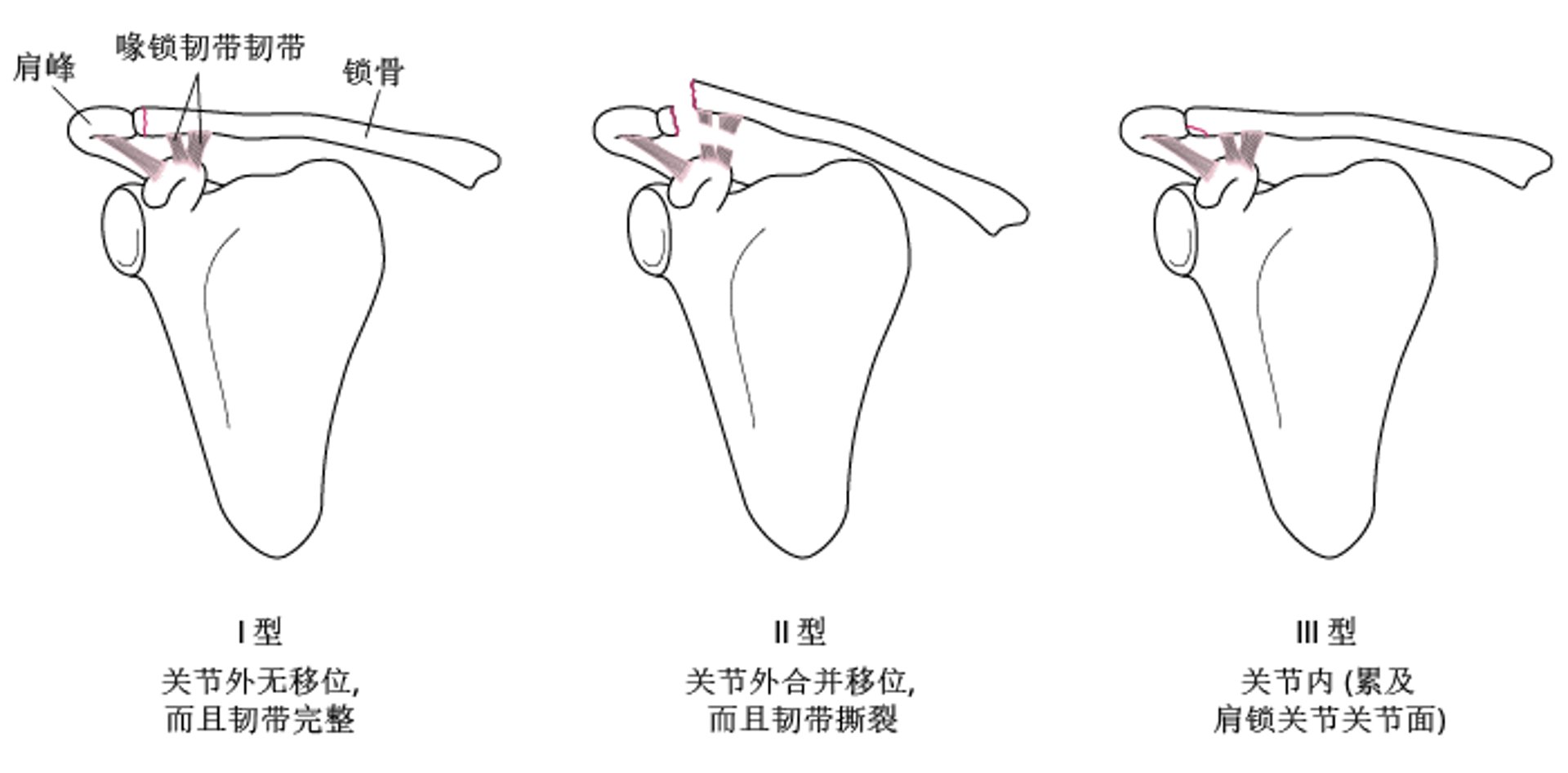 B类锁骨骨折