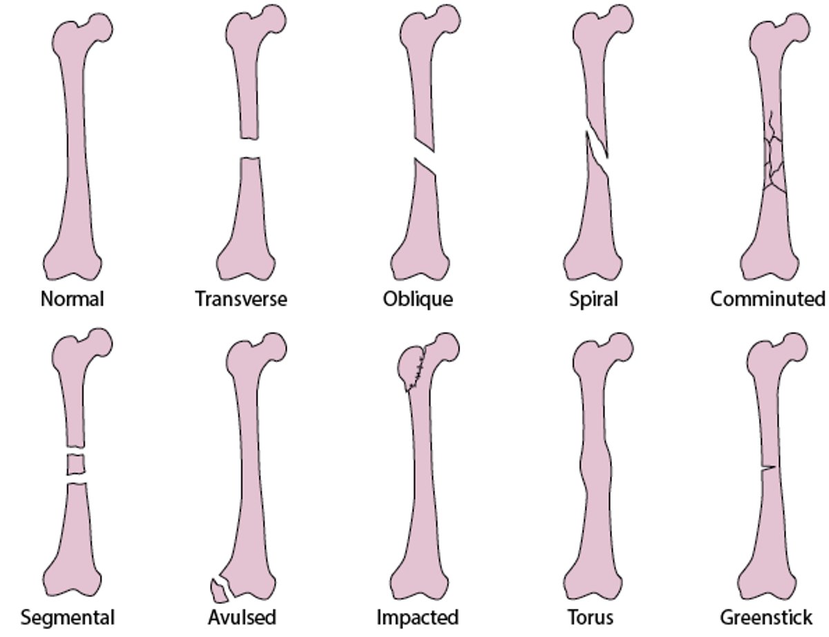 Common Types of Fracture Lines