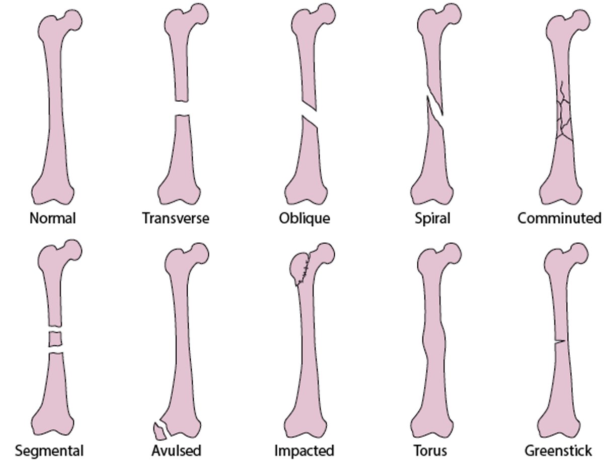 Common types of fracture lines