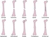 Traits de fracture fréquents