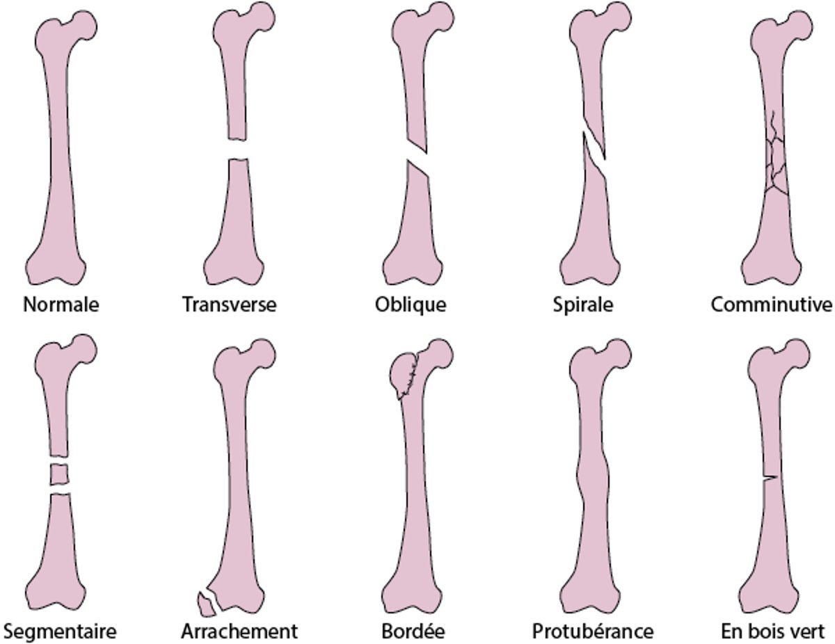 Traits de fracture fréquents