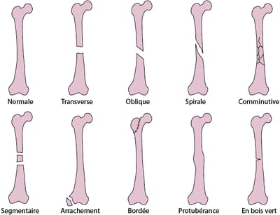 Traits de fracture fréquents