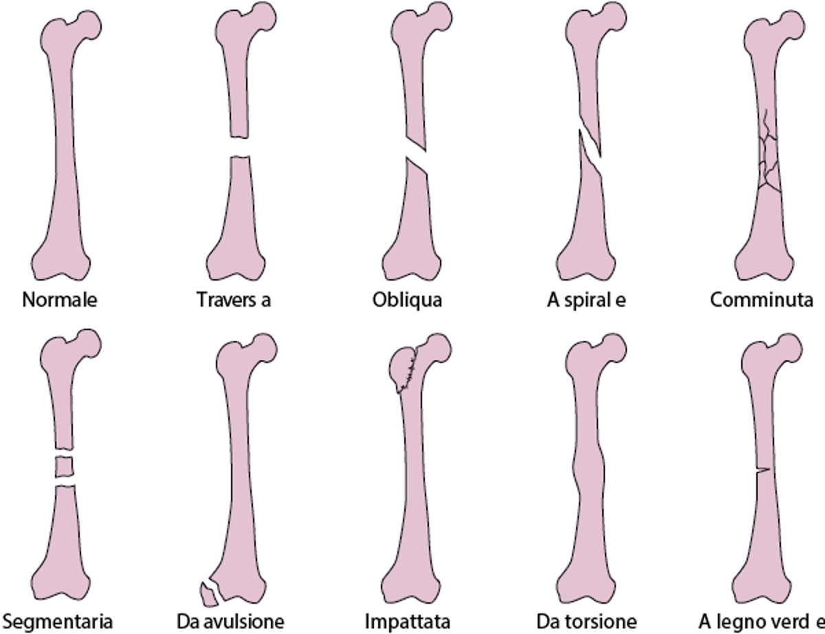 Tipi comuni di rime di frattura