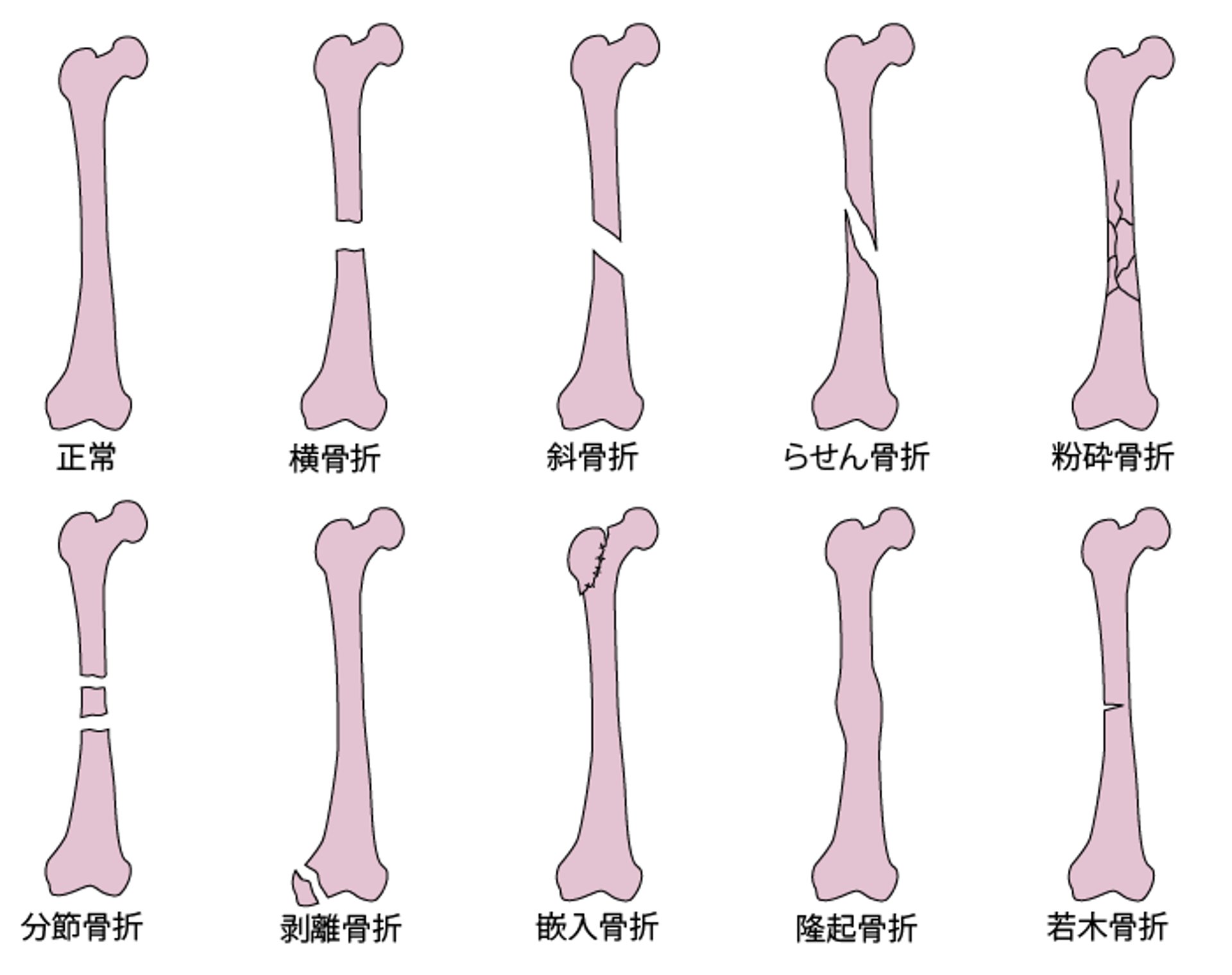 骨折線の一般的な種類
