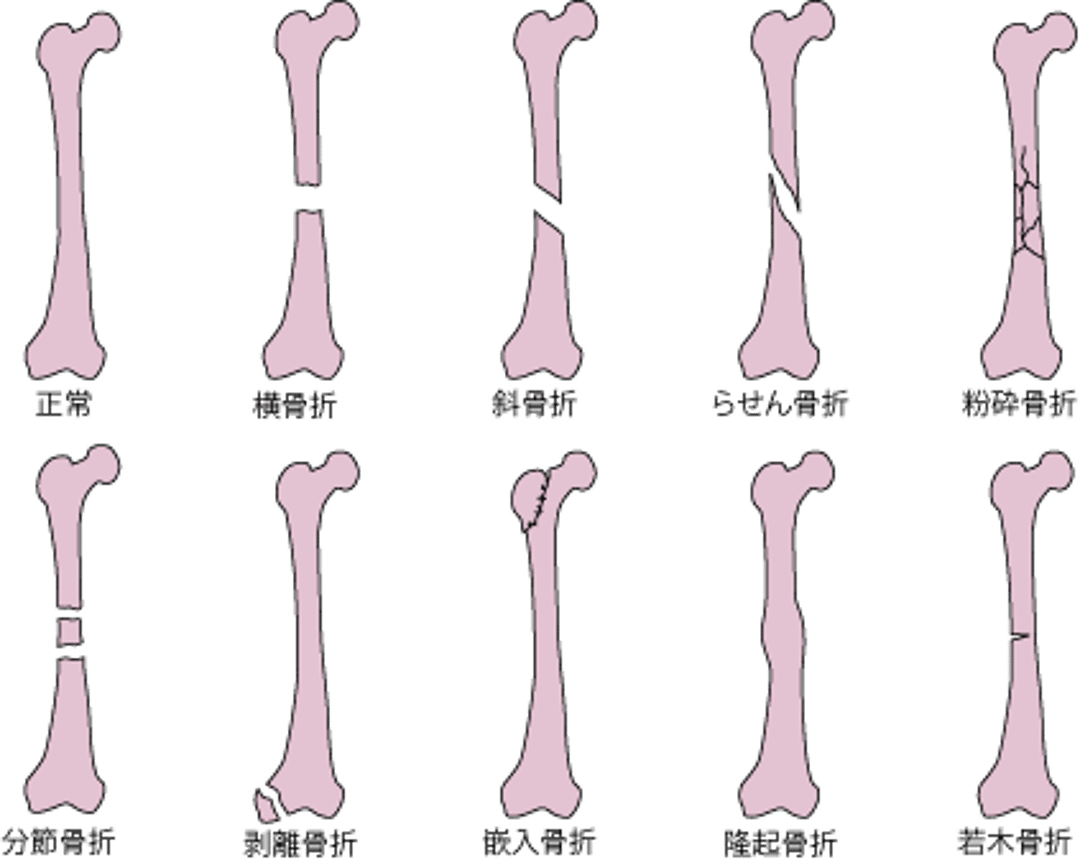骨折線の一般的な種類