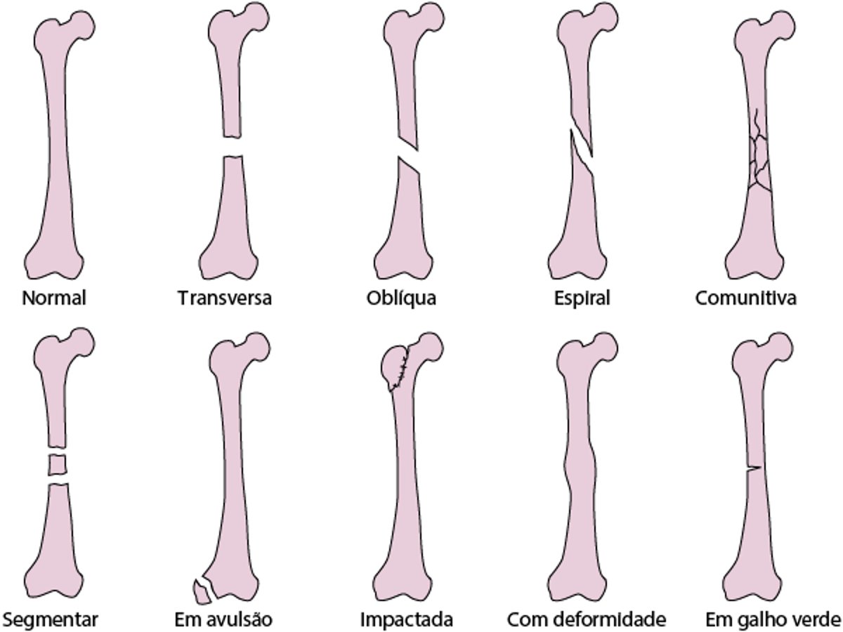 Tipos comuns de linhas de fraturas