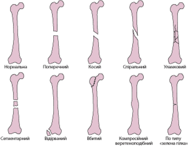Common types of fracture lines