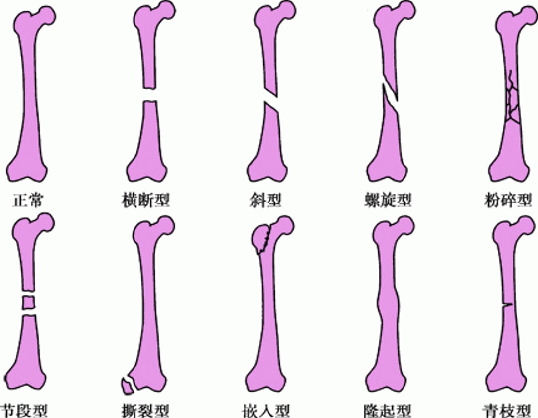 骨折线的常见类型