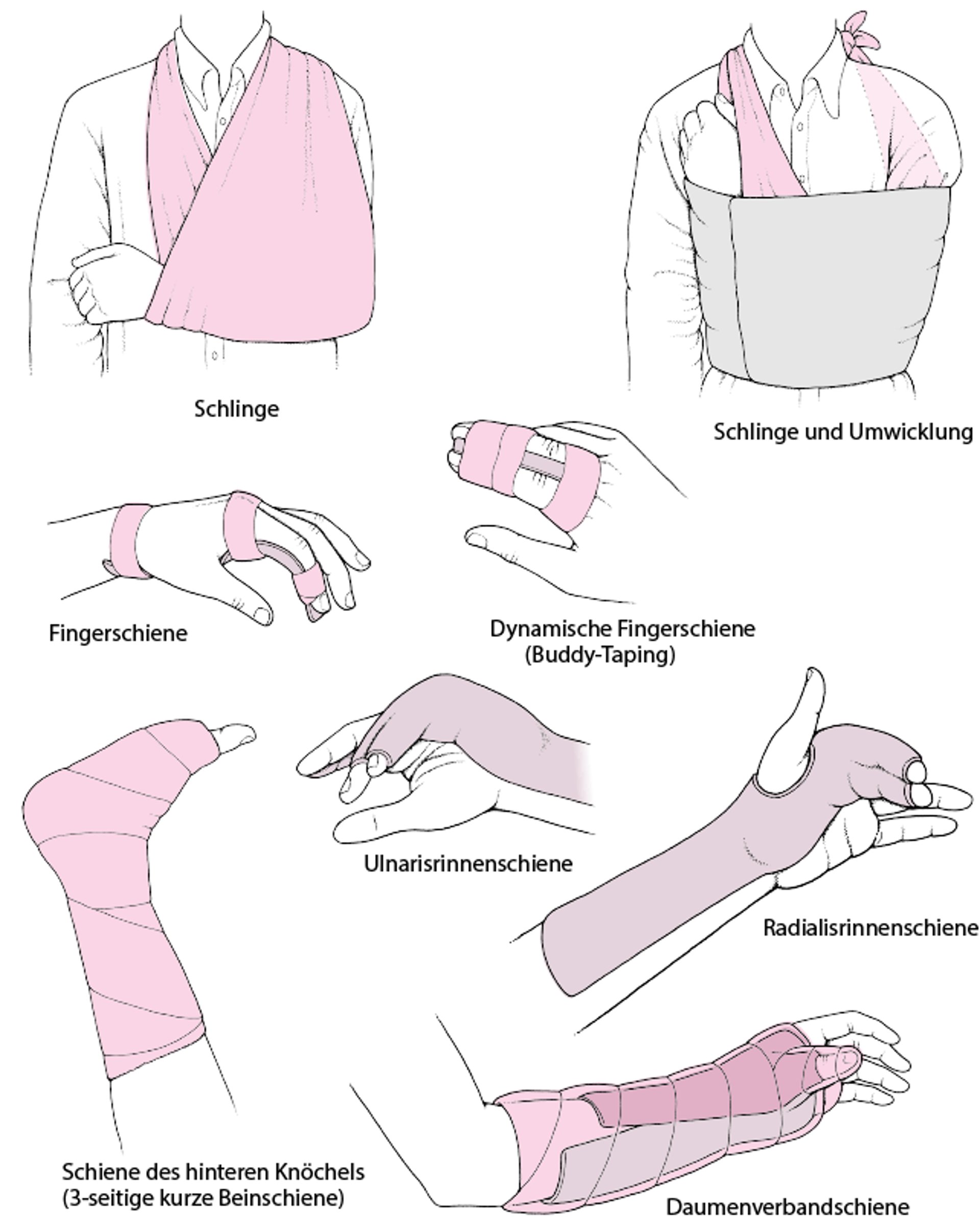 Gelenkimmobilisierung als akute Behandlung: Einige häufig verwendete Techniken