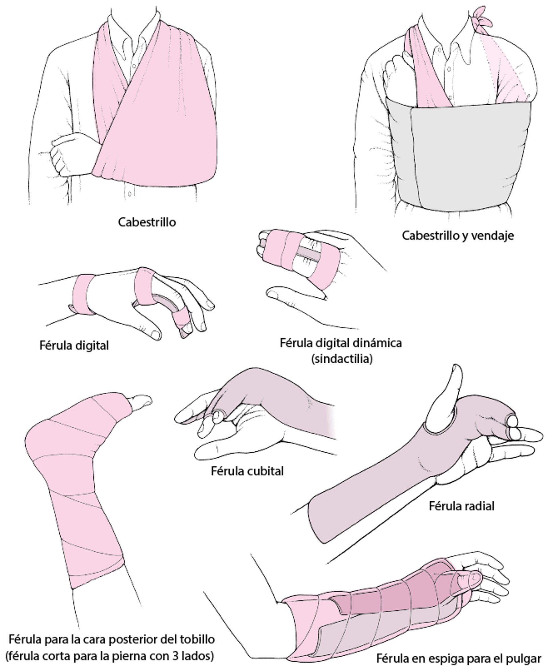 Inmovilización articular como tratamiento agudo: algunas técnicas comunes