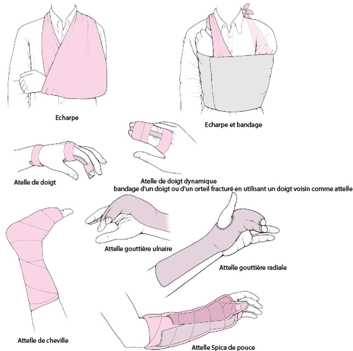 Immobilisation de l'articulation à la phase aiguë: quelques techniques fréquemment utilisées