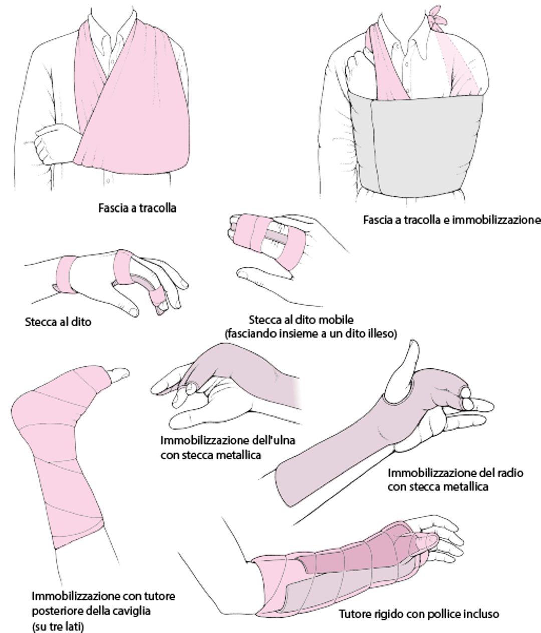Immobilizzazione dell'articolazione interessata come trattamento immediato: alcune tecniche comunemente usate
