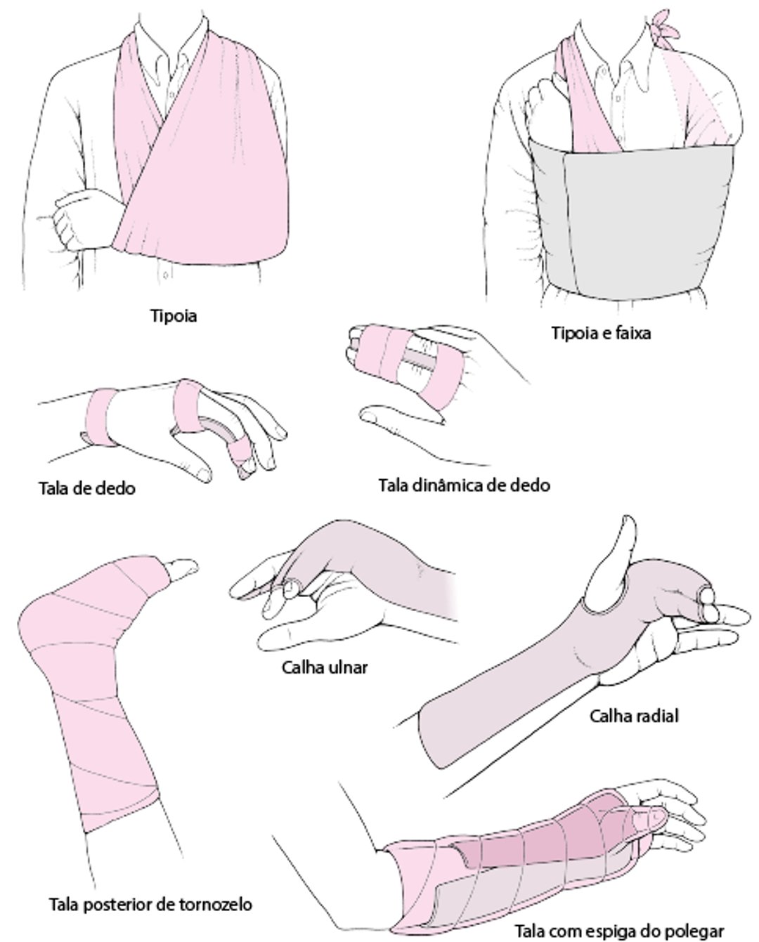 Imobilização articular como tratamento agudo: algumas técnicas comumente utilizadas