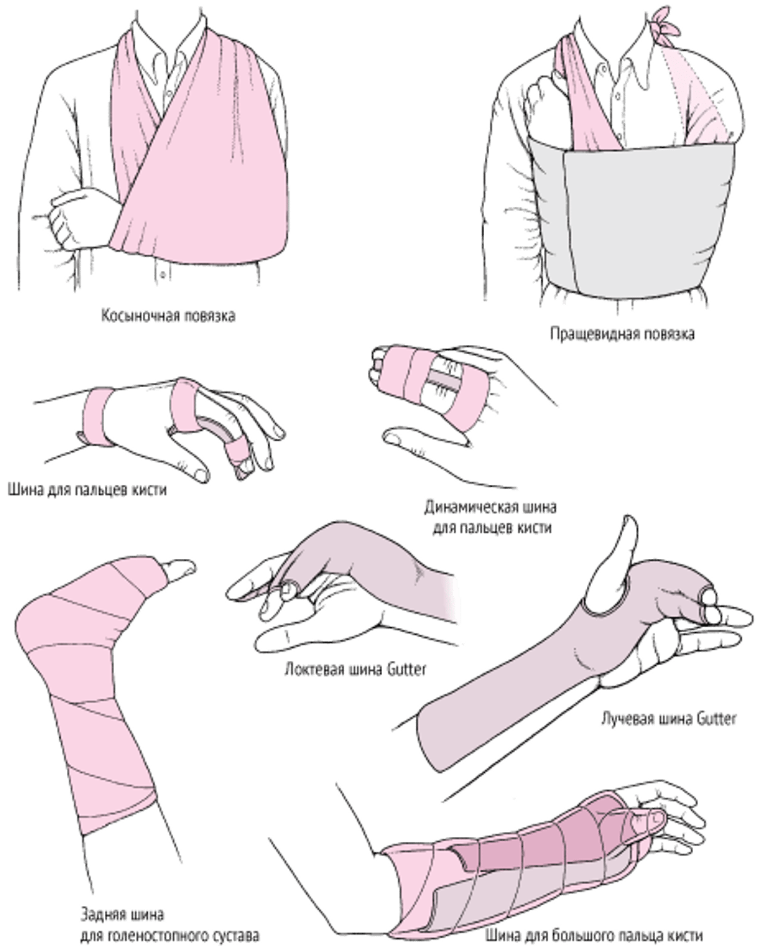 Иммобилизация суставов как экстренное лечение: некоторые широко используемые методики