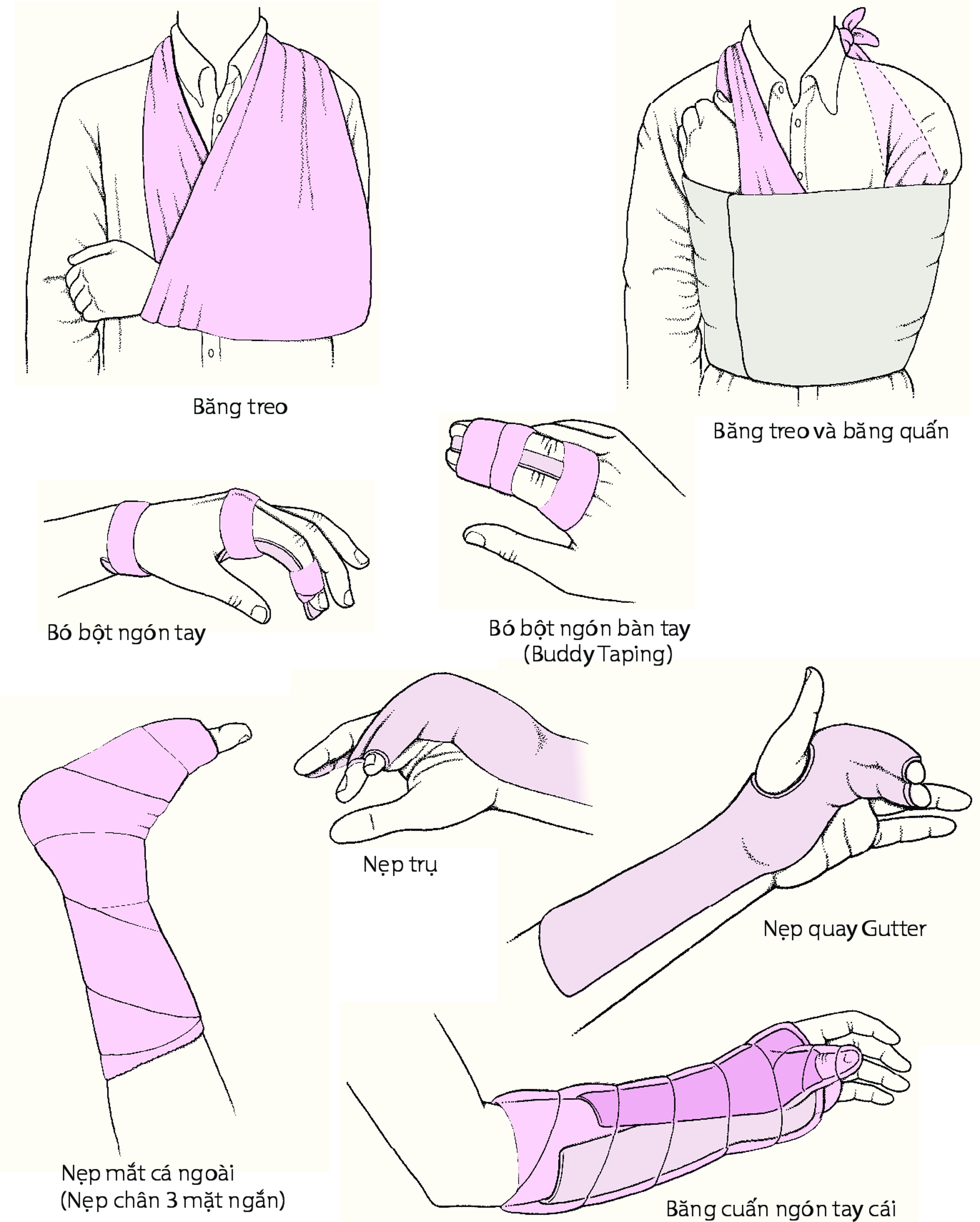 Bất động khớp trong điều trị cấp tính: Một số kỹ thuật thường được sử dụng