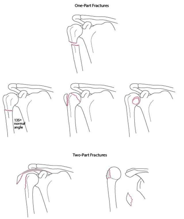 Image:One- and 2-part fractures of the proximal humerus-Merck Manual ...