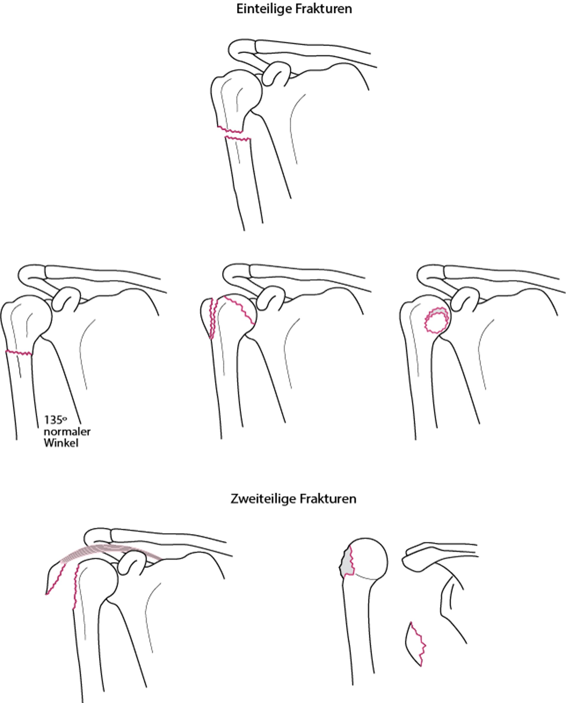Ein- oder 2-Komponenten-Frakturen des proximalen Humerus