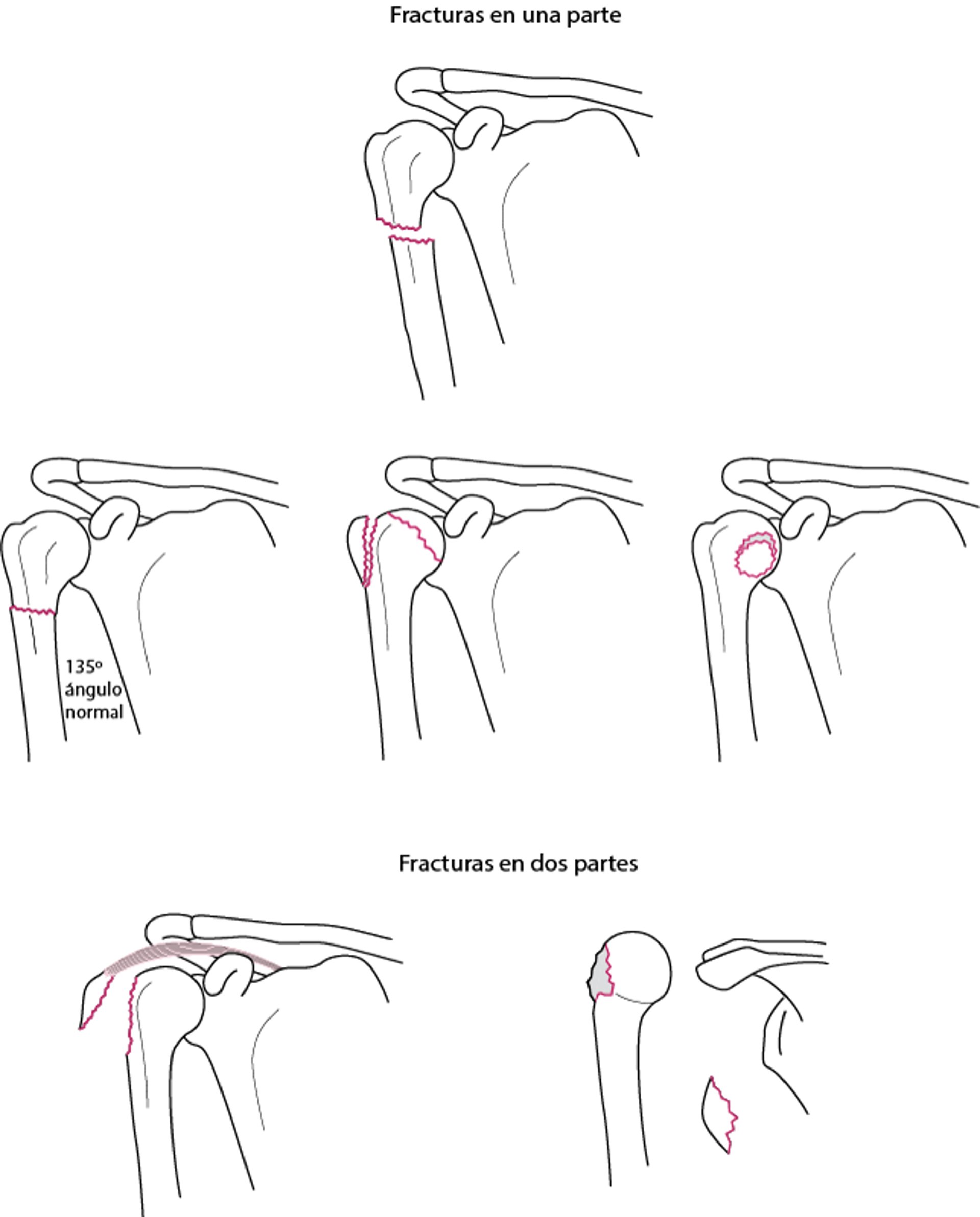 Fracturas de una parte y 2 partes del húmero proximal