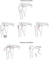 Fractures en une ou deux parties de l'humérus proximal