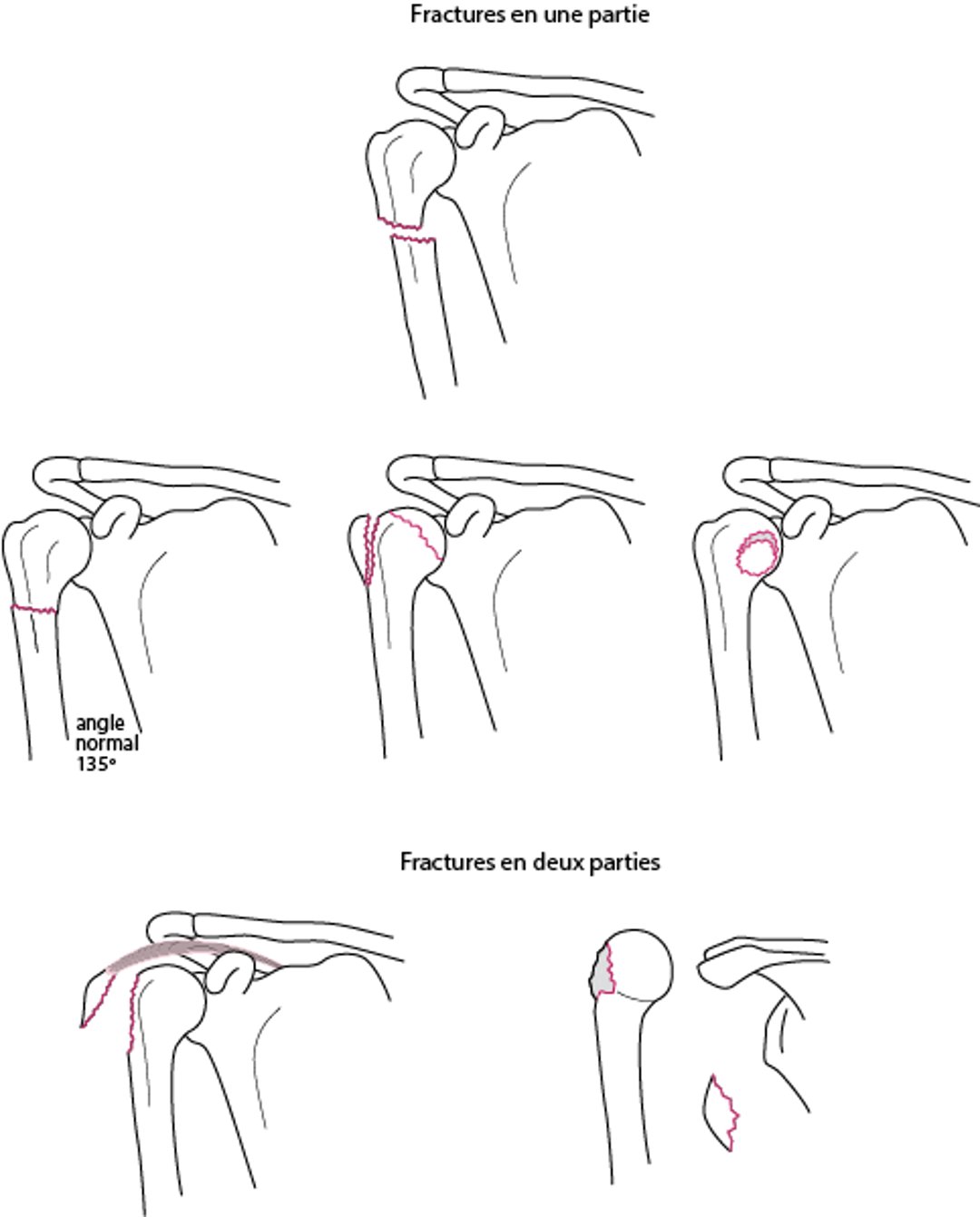 Fractures en une ou deux parties de l'humérus proximal