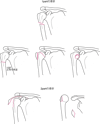 上腕骨近位部の1partまたは2partの骨折
