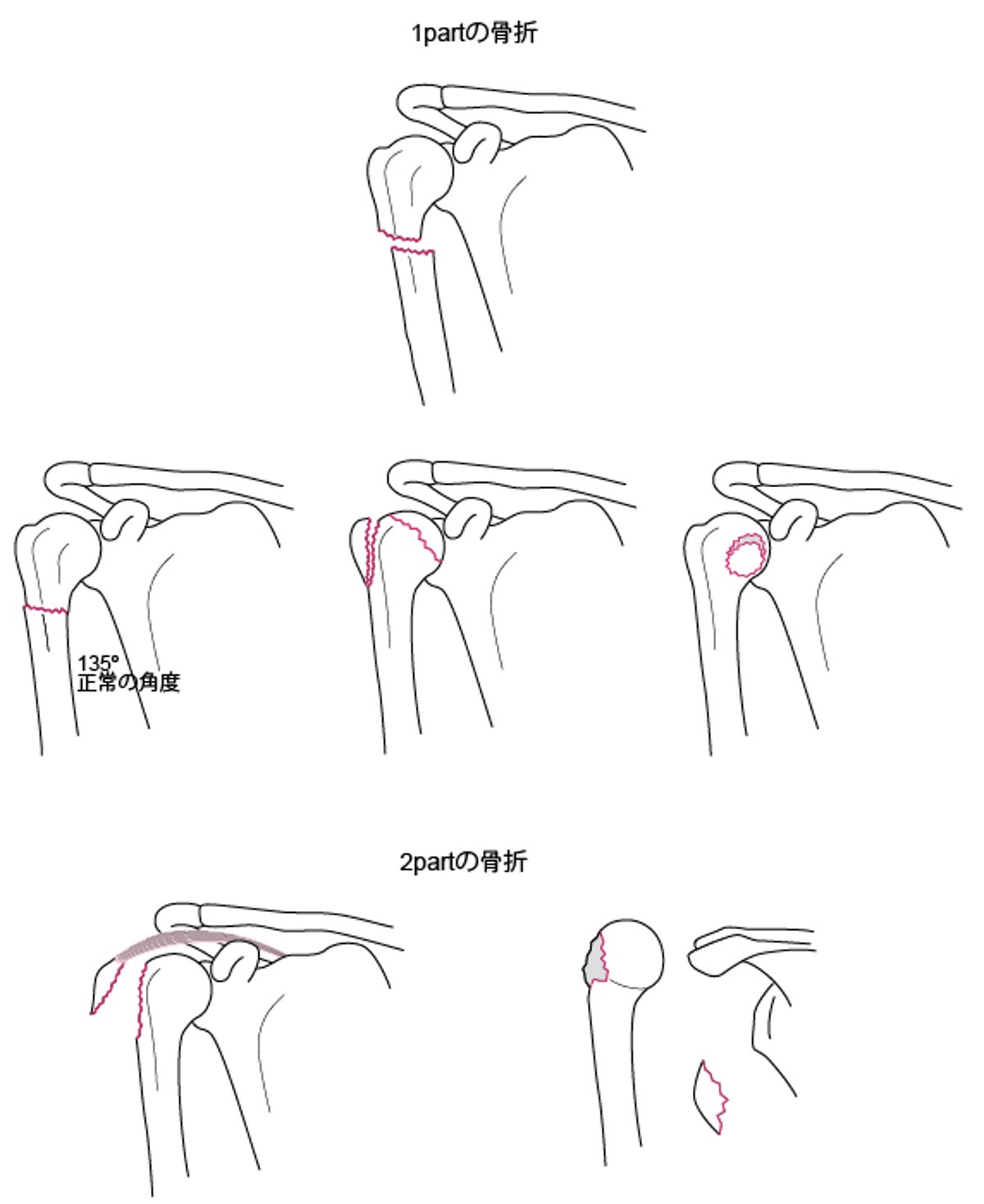 上腕骨近位部の1partまたは2partの骨折