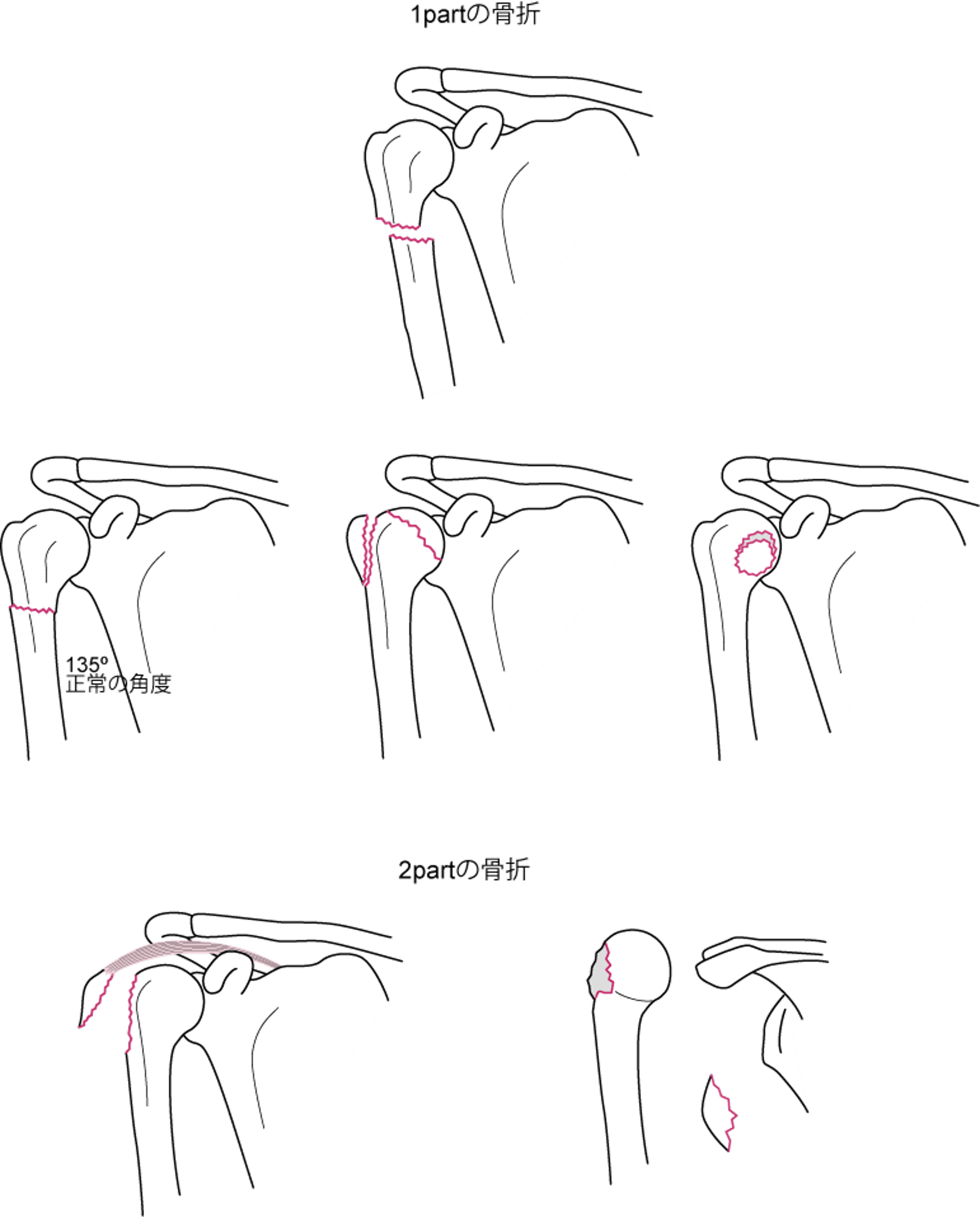 上腕骨近位部の1partまたは2partの骨折