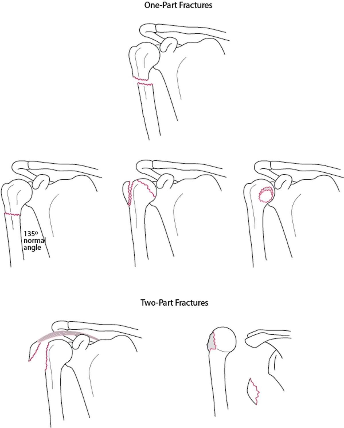 Fraturas da região proximal do úmero com uma e 2 partes